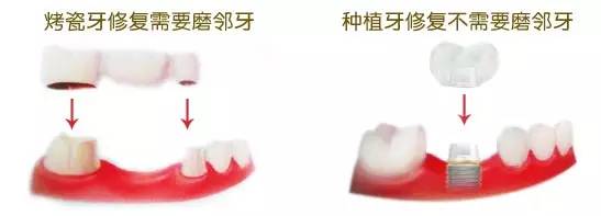 杭州牙齿修复